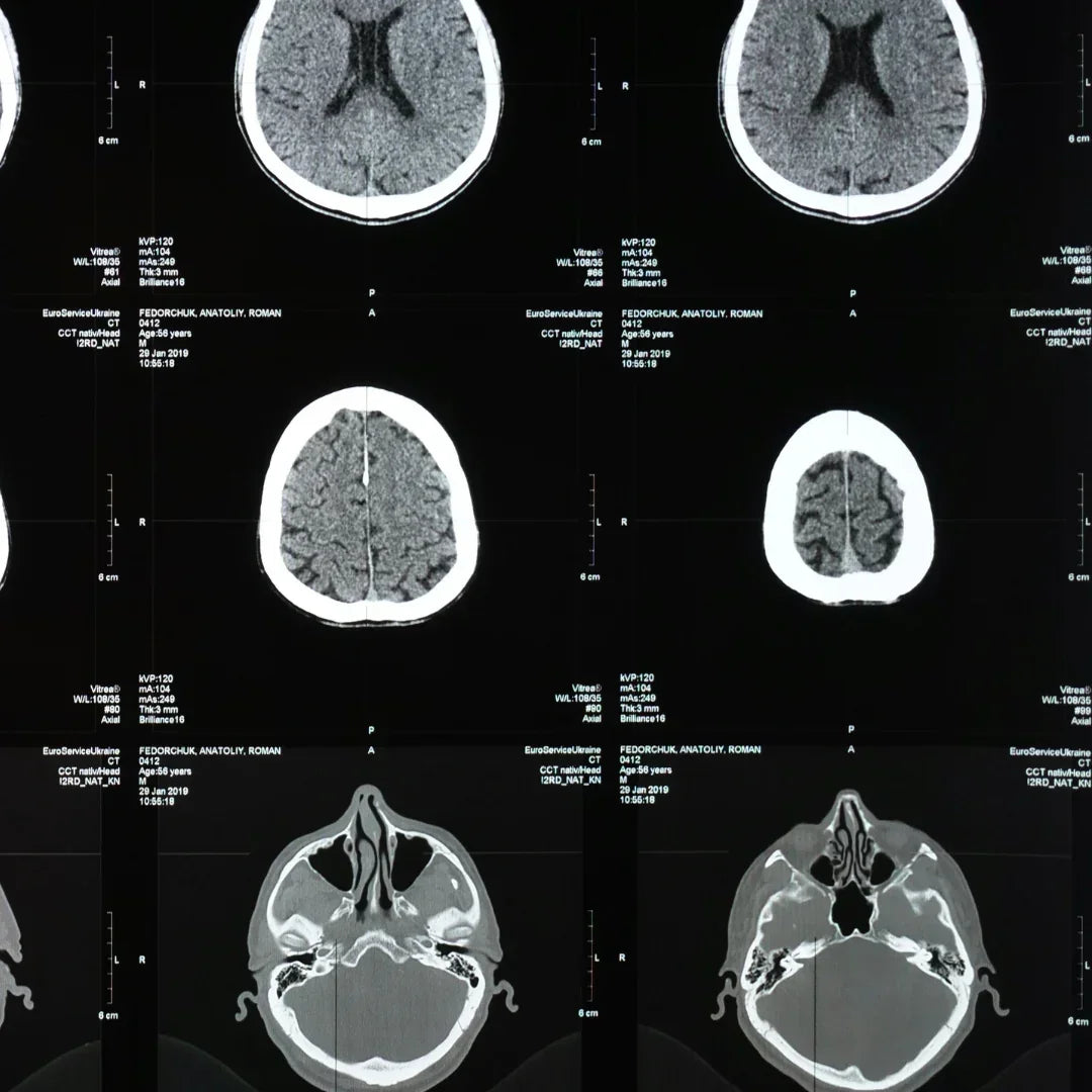 Brain MRI scans showing cross-sections, stamox beetroot powder supports brain health